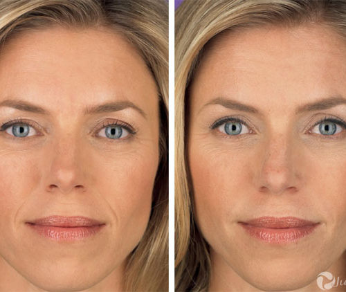 Botox-Juvederm Cosmetics. What is BOTOX Cosmetic?